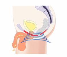 illustration of a man's pelvic floor receiving BTL Emsella treatment